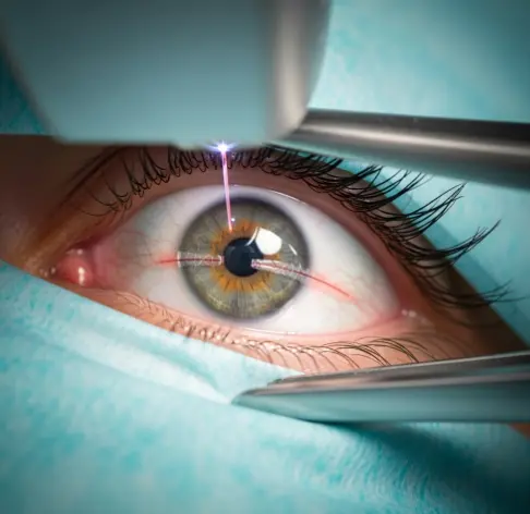 스마일라식 라식/라섹-1